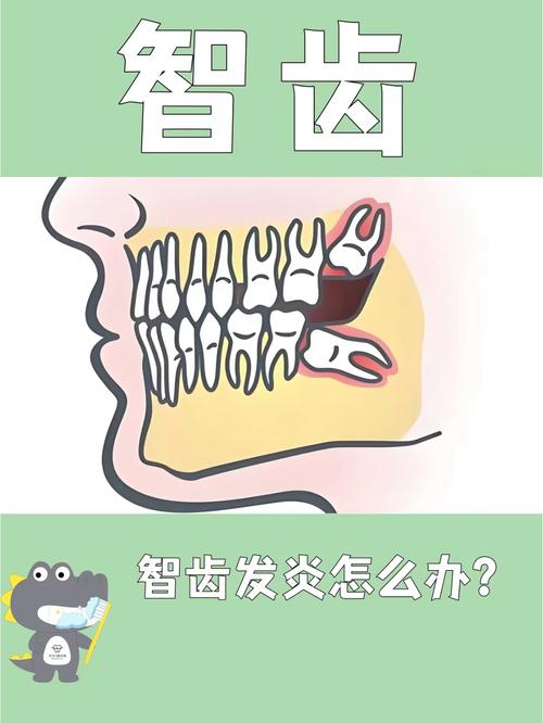 智齿为什么容易发炎