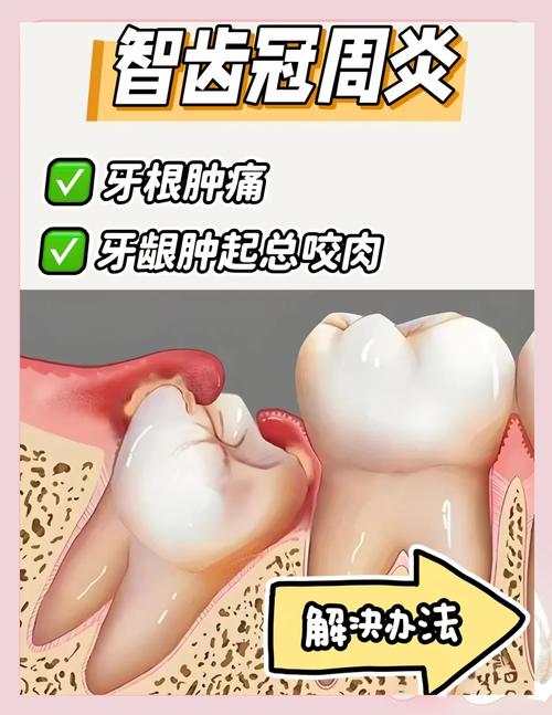 智齿为什么容易发炎
