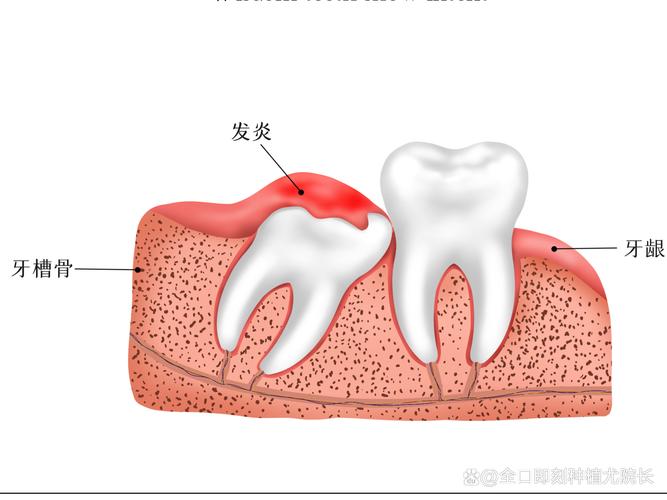 智齿为什么容易发炎