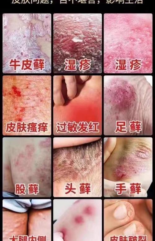 什么办法可以止痒