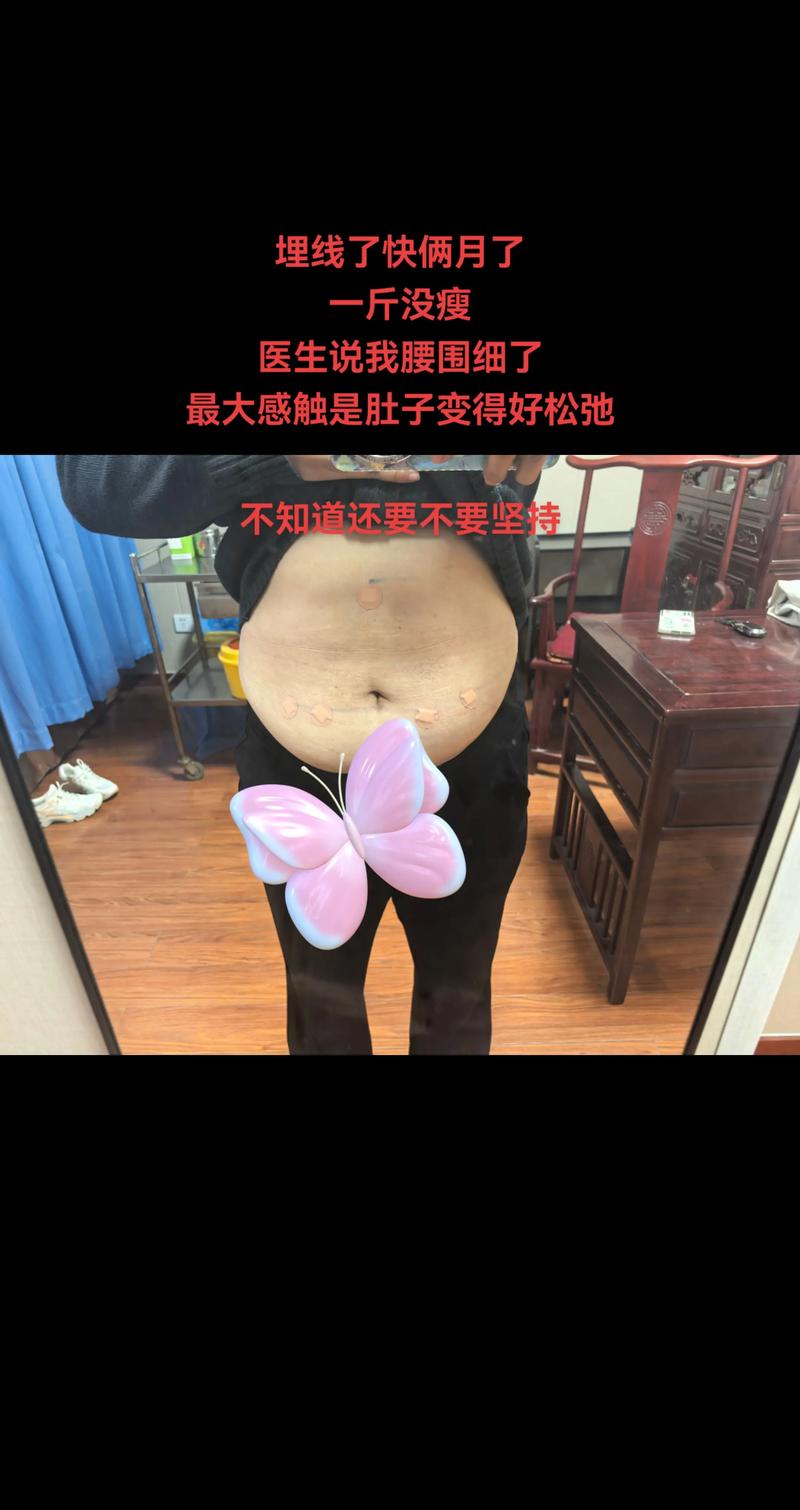 埋线减肥吃些什么