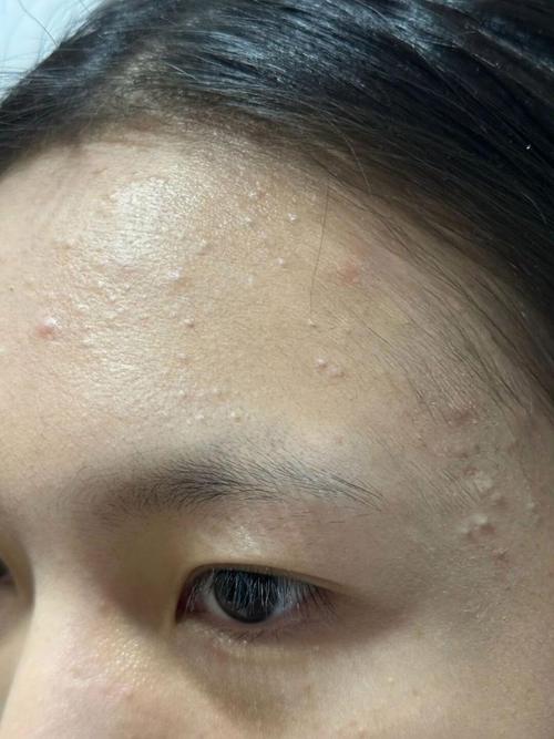 脸上的小颗粒是什么