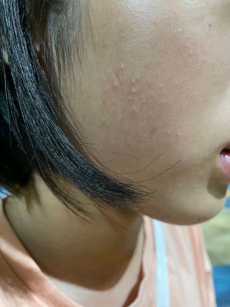 脸上的小颗粒是什么