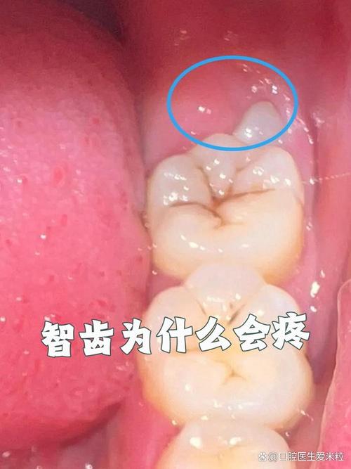 为什么智齿容易发炎