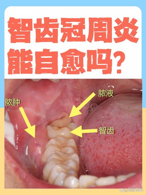 为什么智齿容易发炎