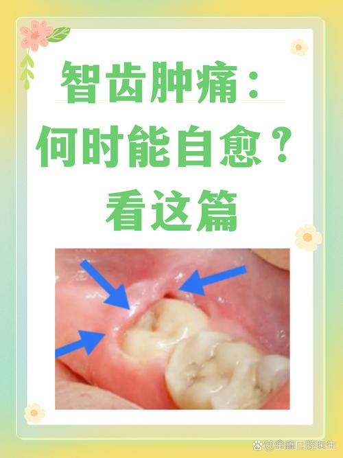 为什么智齿容易发炎