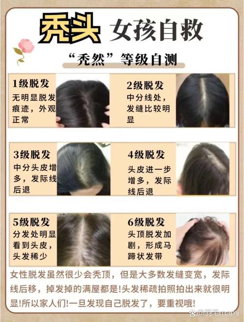 女掉头发是什么原因