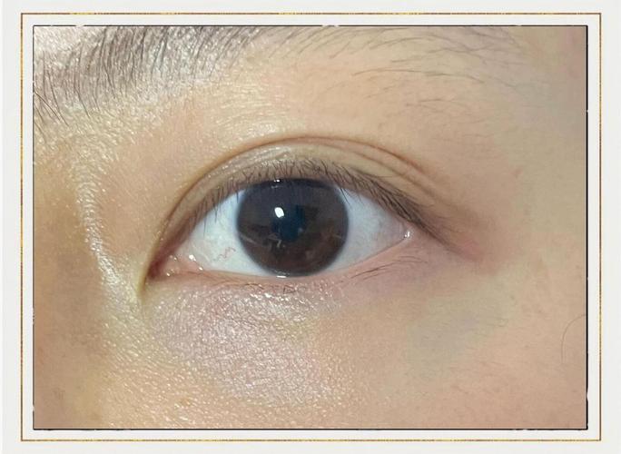 为什么有三眼皮