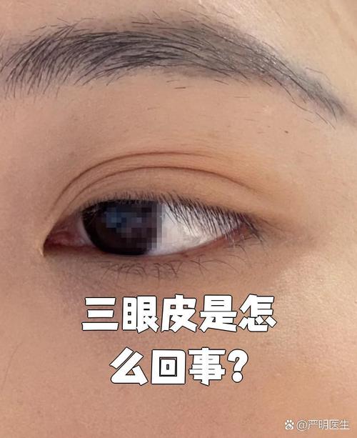 为什么有三眼皮