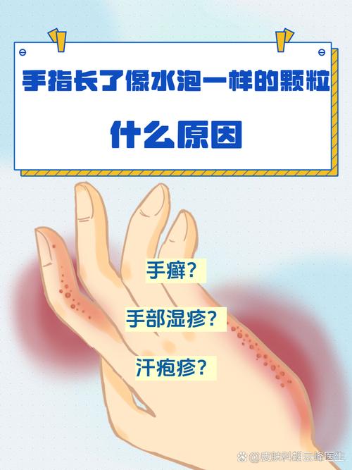 手上起小水泡是什么