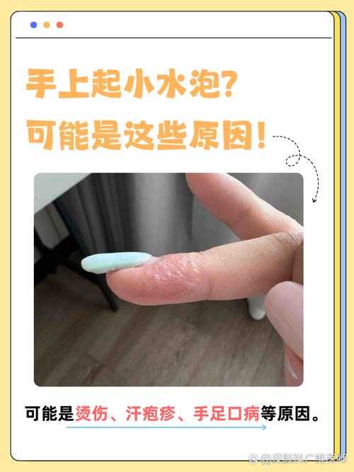 手上起小水泡是什么