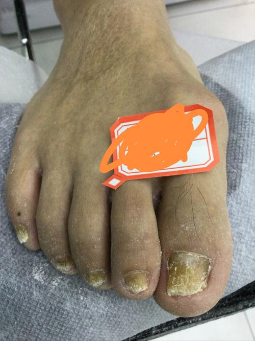 灰指甲是什么颜色