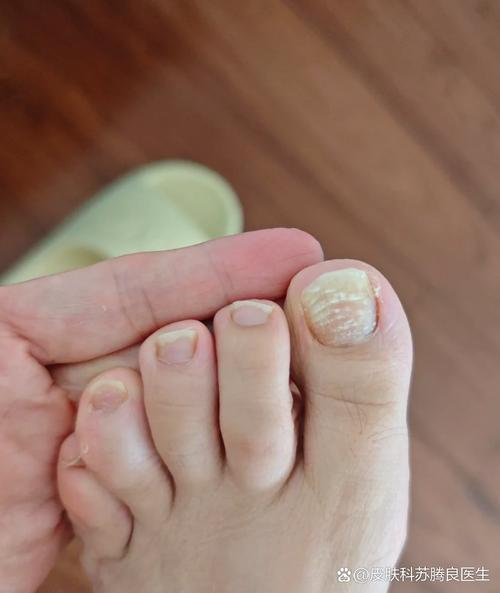 灰指甲是什么颜色