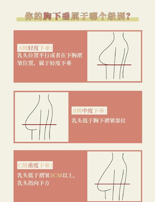 胸下垂什么意思