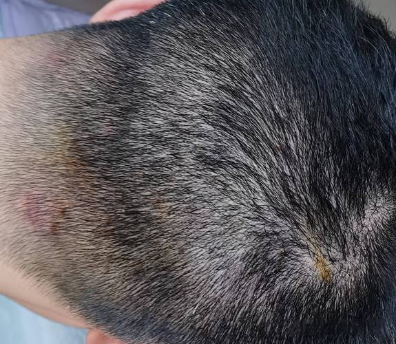 毛囊炎是什么样子的