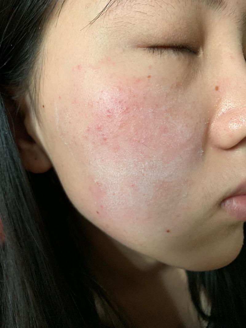 什么会引起皮肤过敏