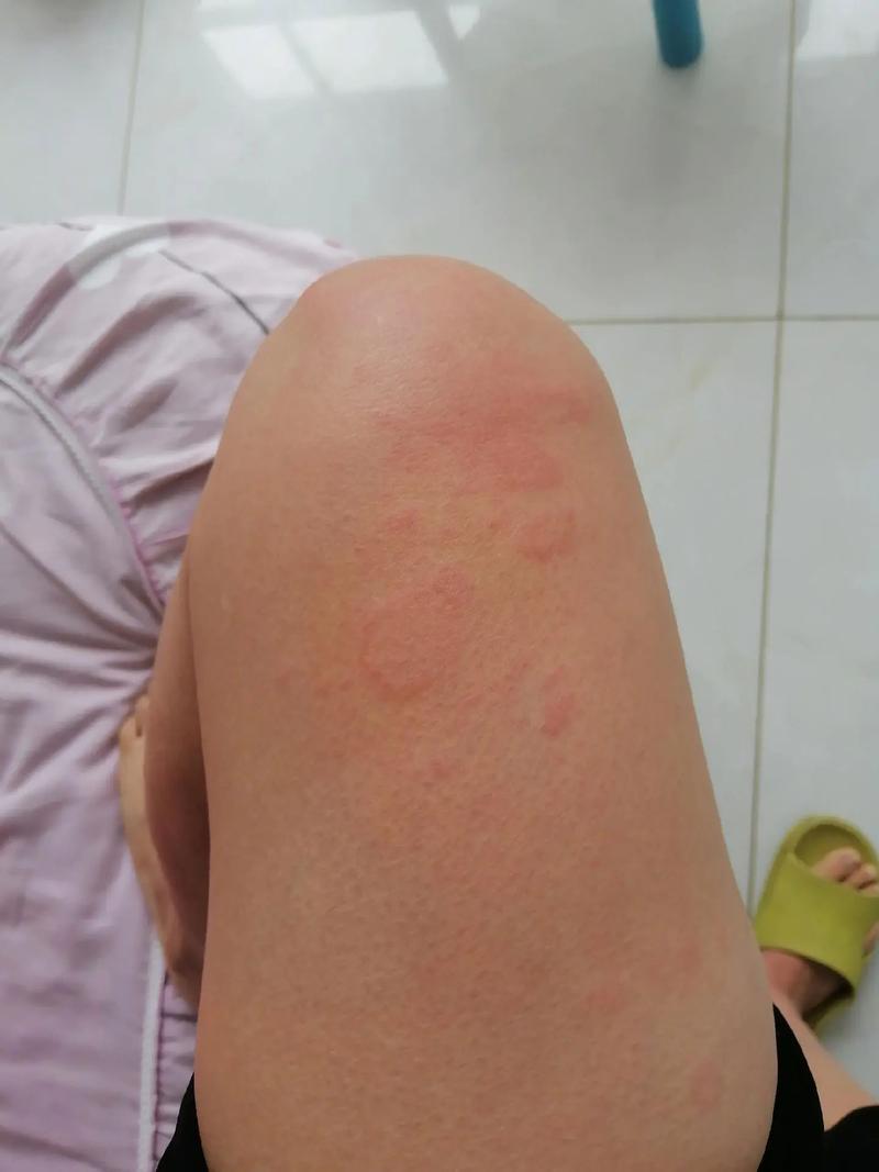 什么会引起皮肤过敏