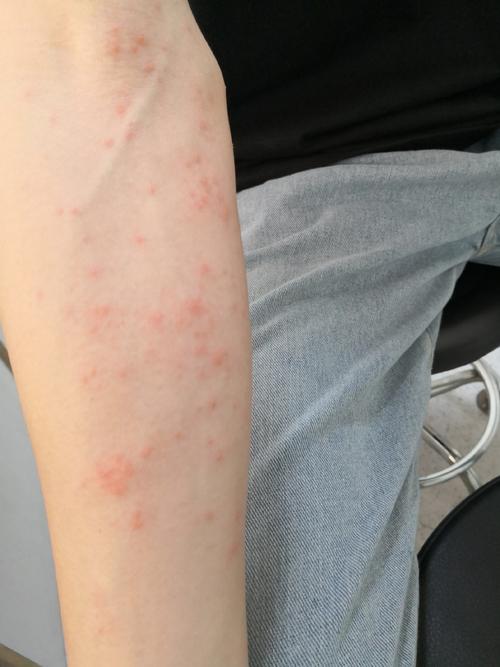 什么会引起皮肤过敏