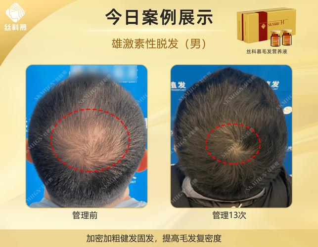 脱发与什么有关