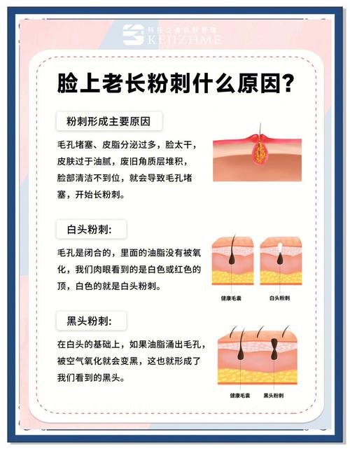 粉刺是什么原因引起的