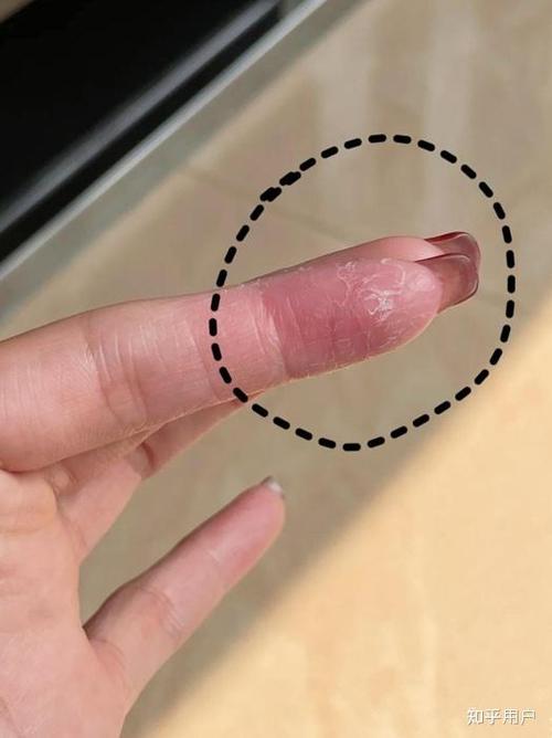 手指起皮缺什么