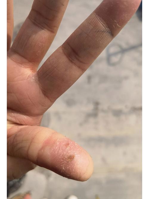 手指起皮缺什么
