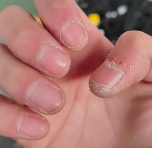 手指起皮缺什么