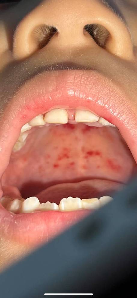 口腔出血是什么病