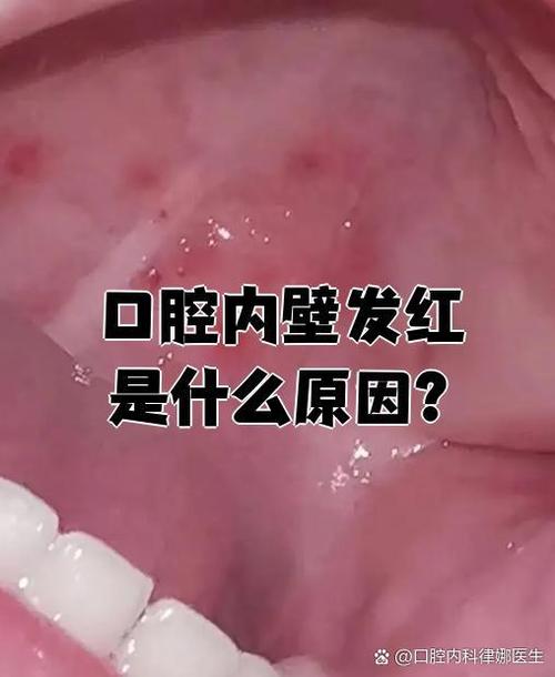 口腔出血是什么病