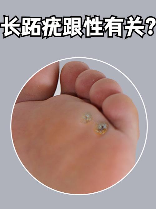 跖疣是什么病毒