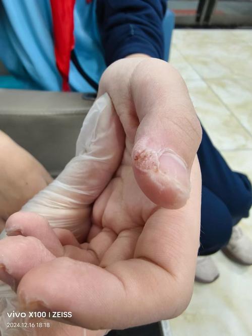 跖疣是什么病毒