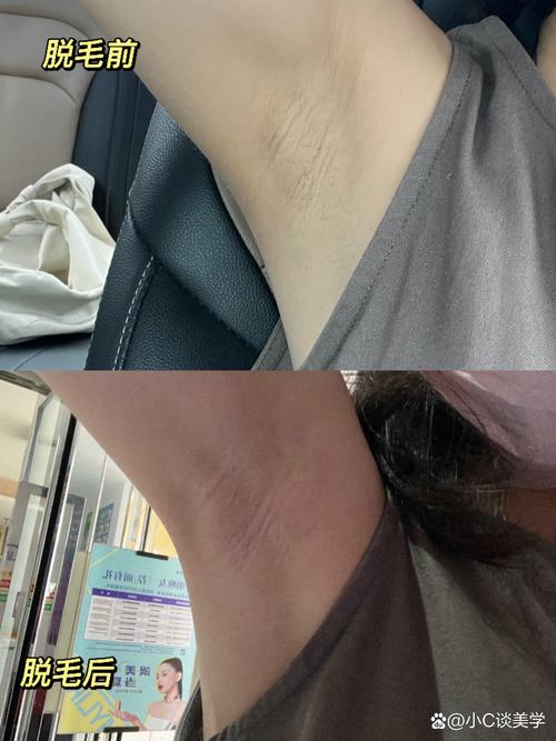 什么是激光脱毛