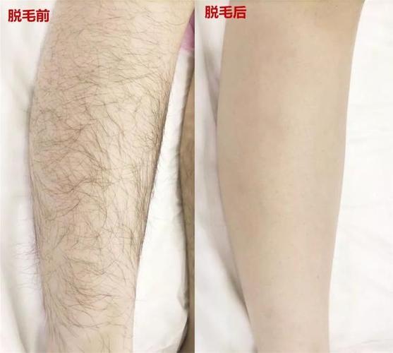 什么是激光脱毛