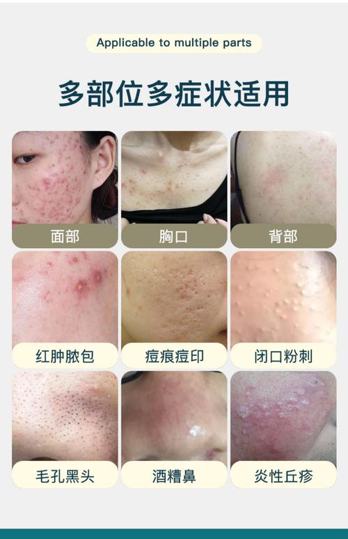 长青春痘用什么药