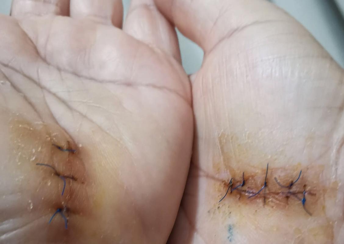 手术后什么时候拆线