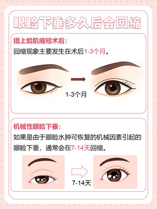 眼皮为什么会下垂