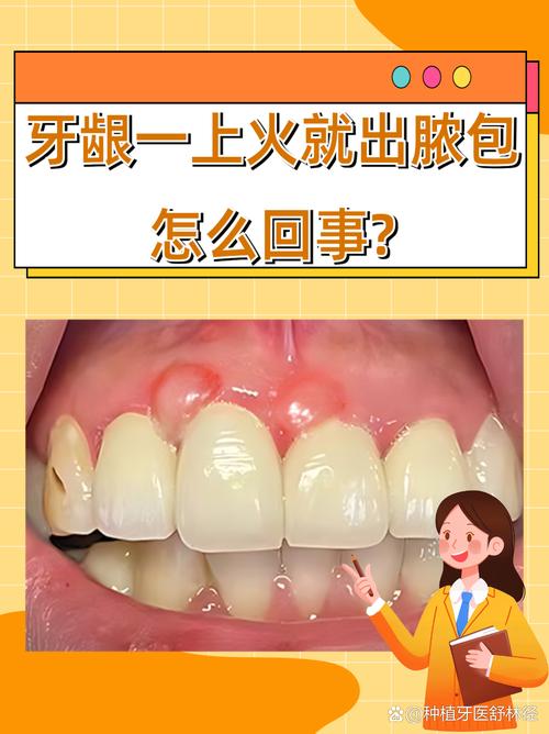 牙龈上火是什么原因