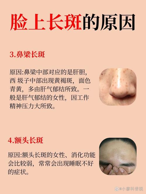 额头长斑是什么原因