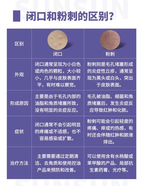 有粉刺是什么原因