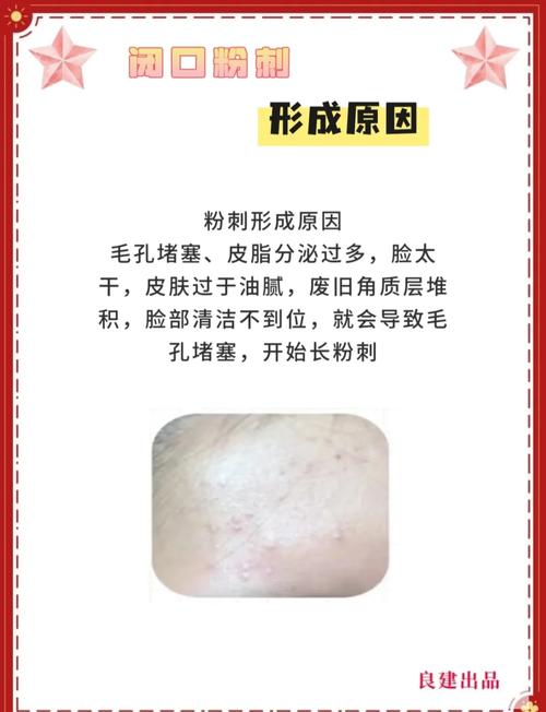 有粉刺是什么原因