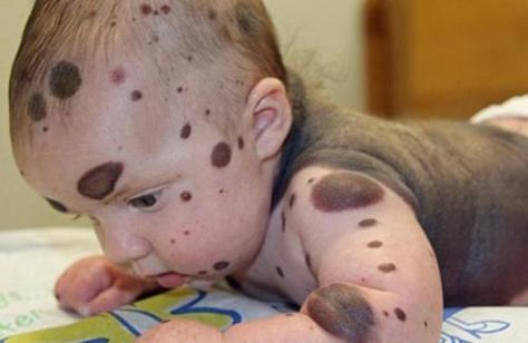 为什么小孩有胎记