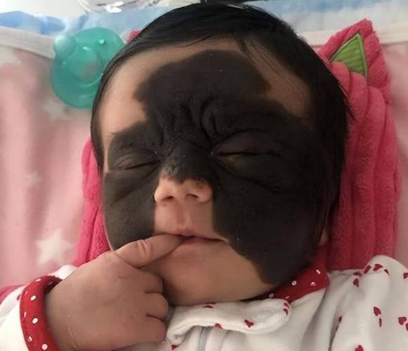 小孩为什么有胎记