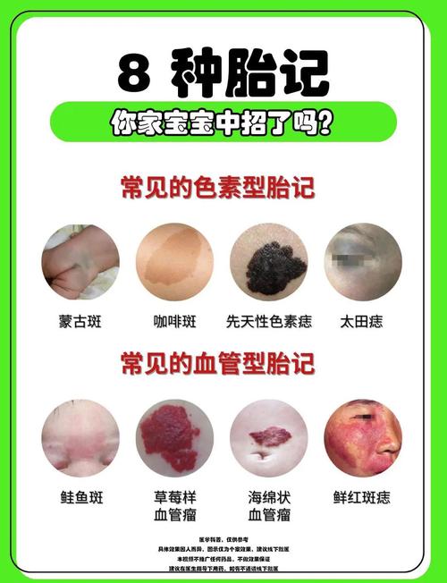 小孩为什么有胎记