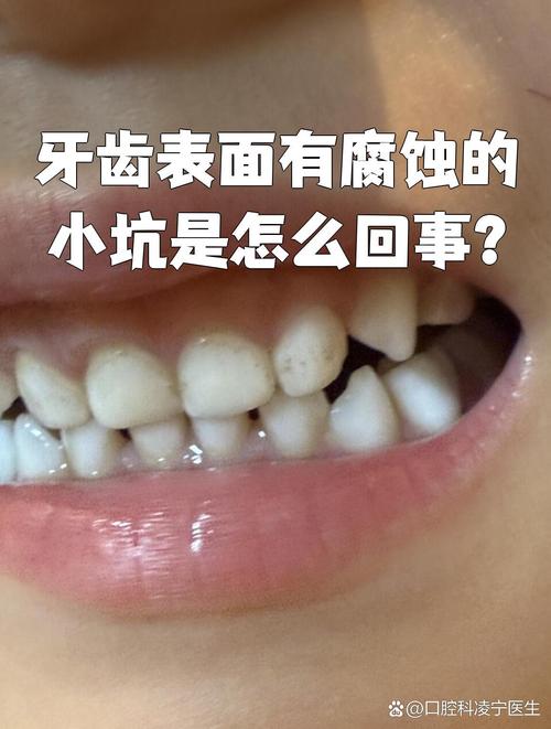 龋齿有什么症状