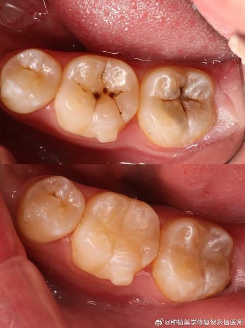 龋齿有什么症状