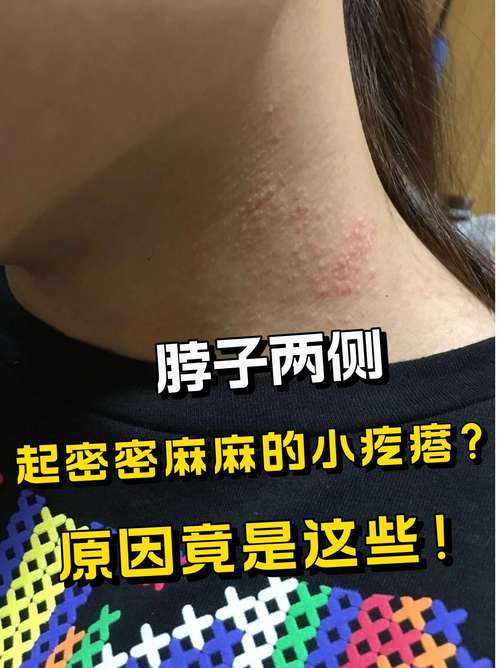 脖子上长痘什么原因