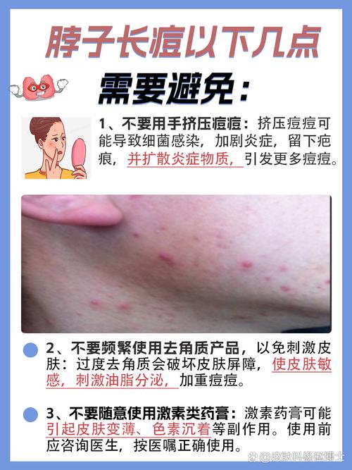 脖子上长痘什么原因