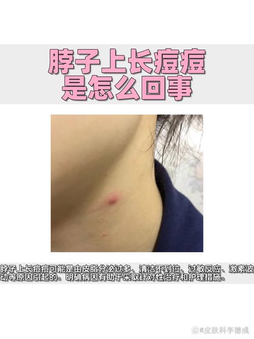 脖子上长痘什么原因