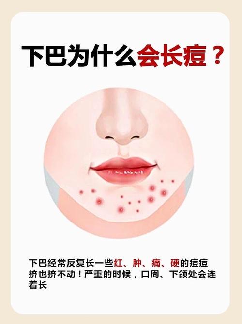 为什么下面会长痘