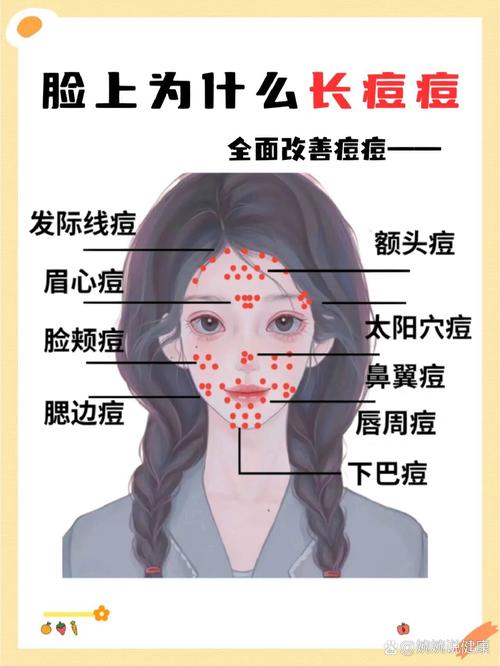 脸上为什么总长痘